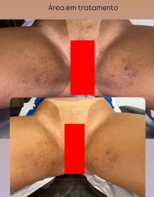 Peeling químico (tratamento a distância) para 2 áreas, você que não mora em Salvador e quer fazer o seu clareamento